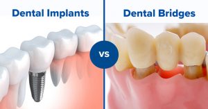 Health Benefits and Disadvantages of Dental Implants